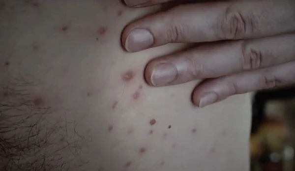 Masalu uzliesmojumā konstatēti vēl divi saslimšanas gadījumi