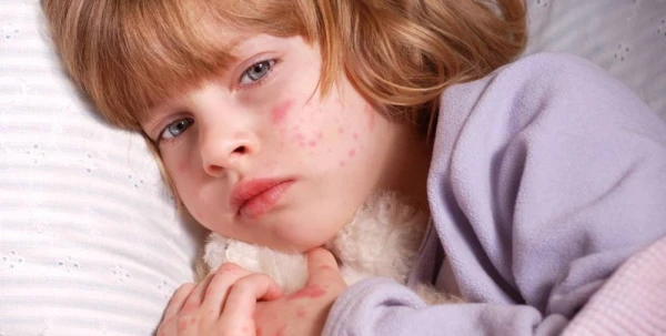 Katrs desmitais trīs gadus vecais bērns nav aizsargāts pret masalām