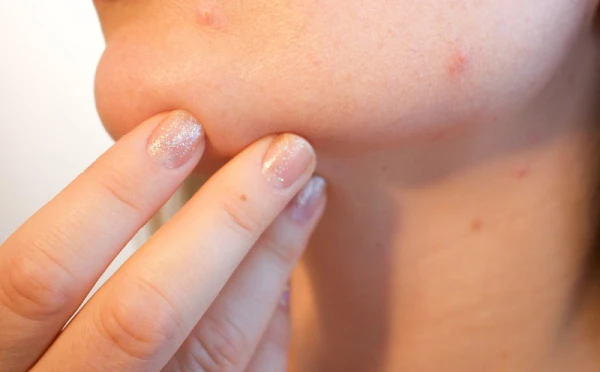 Sejas karte: ko var nozīmēt pūtītes