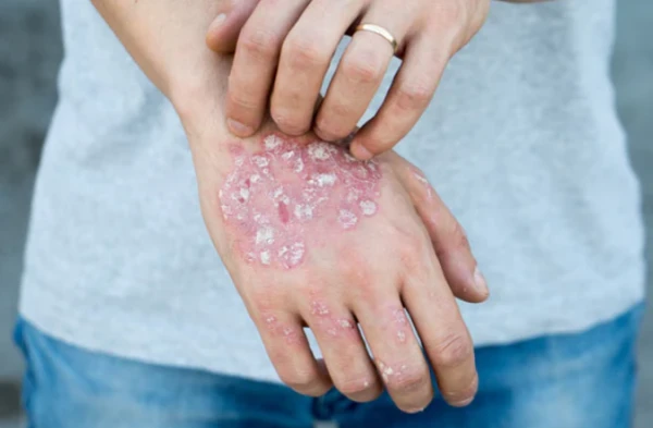 Медики ищут способов борьбы с напастью.