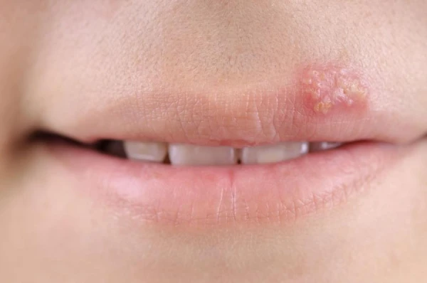 Neārstojošs herpes: ārsts skaidro tā bīstamību