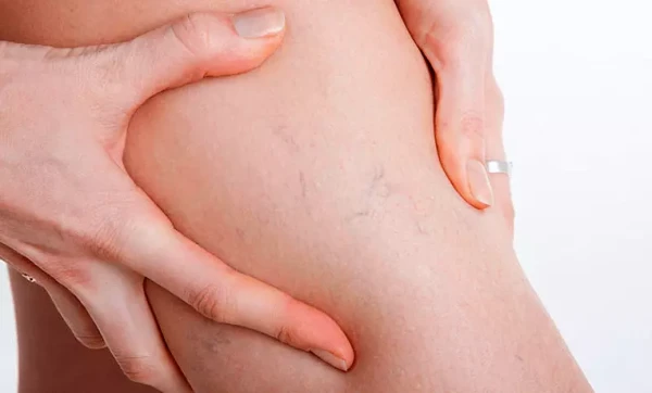 Kad uz kājām redzamas vēnas: vienkāršas pazīmes, kas prasa speciālista uzmanību