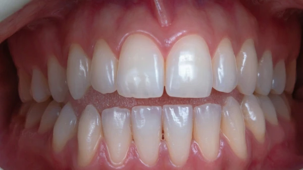 Atklāts negaidīts iemesls palielinātam zobu zaudēšanas riskam