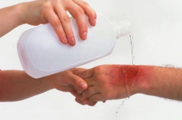 Kā sniegt palīdzību apdeguma gadījumā mājas apstākļos?