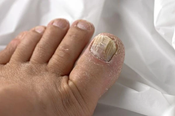 Vai ar hennu var atbrīvoties no ādas un nagu sēnītes?